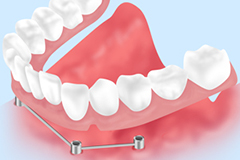 インプラントオーバーデンチャー