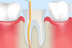 根管治療の目的