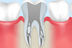 根管治療の目的